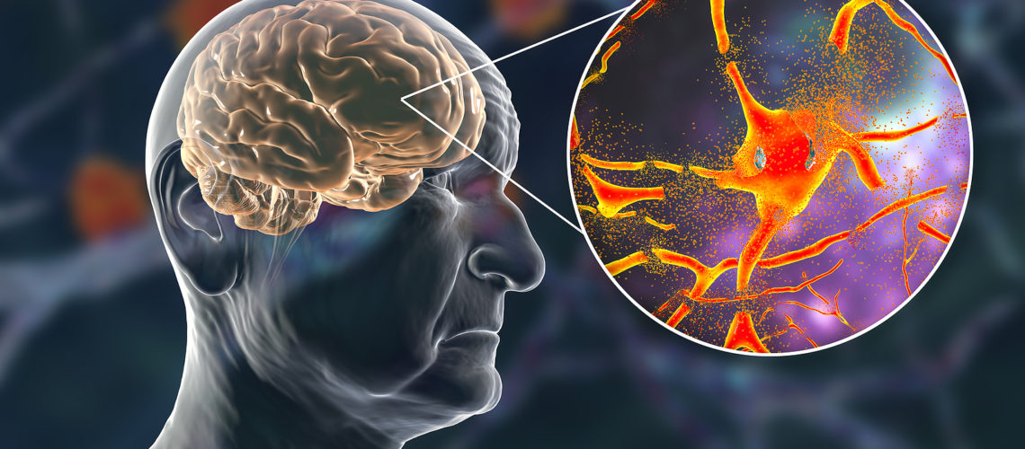 Dementia and Alzheimer's disease medical concept, 3D illustration. Memory loss, brain aging. Conceptual image showing progressive impairment of brain functions in elderly age. Neurodegeneration